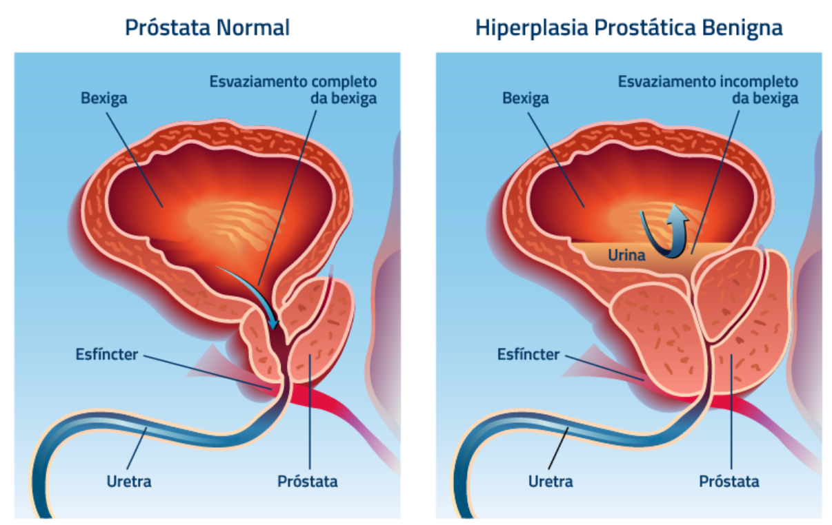 Hiperplasia de Próstata Benigna - Urologia Integrada